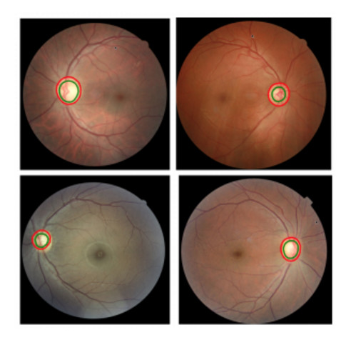 继DeepMind 致力眼疾后，IBM 的认知计算能诊断95% 的早期青光眼